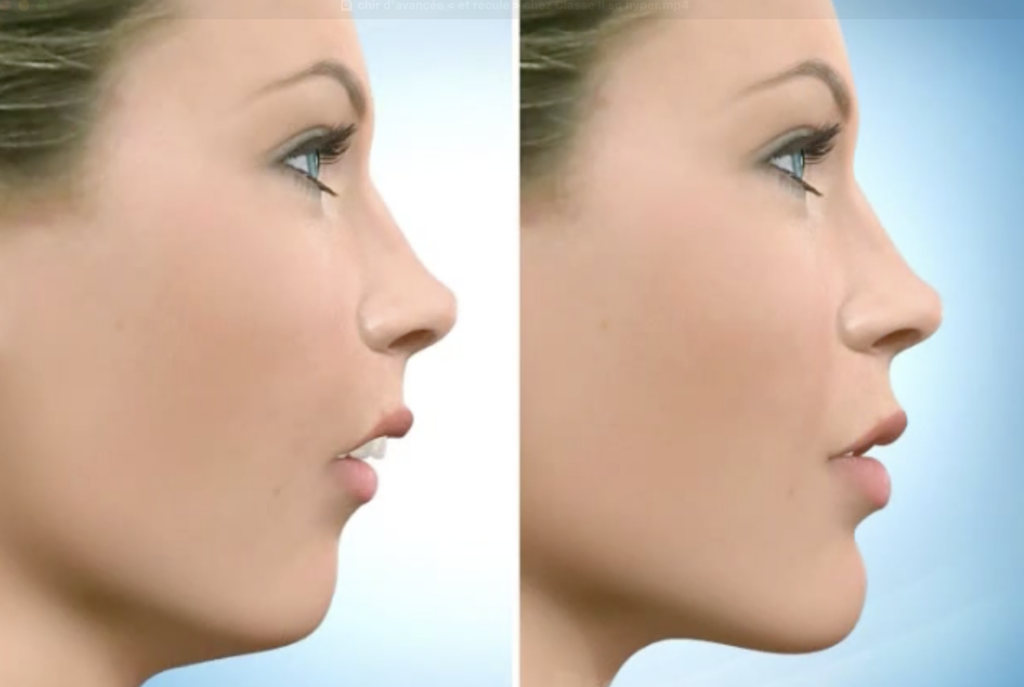 Chirurgie Orthognathique : Tout ce qu’il faut savoir