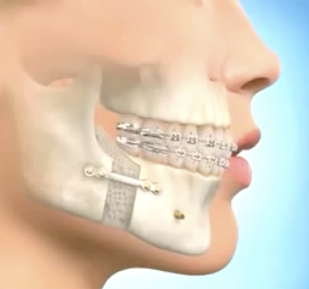 Chirurgie Orthognathique : Tout ce qu’il faut savoir