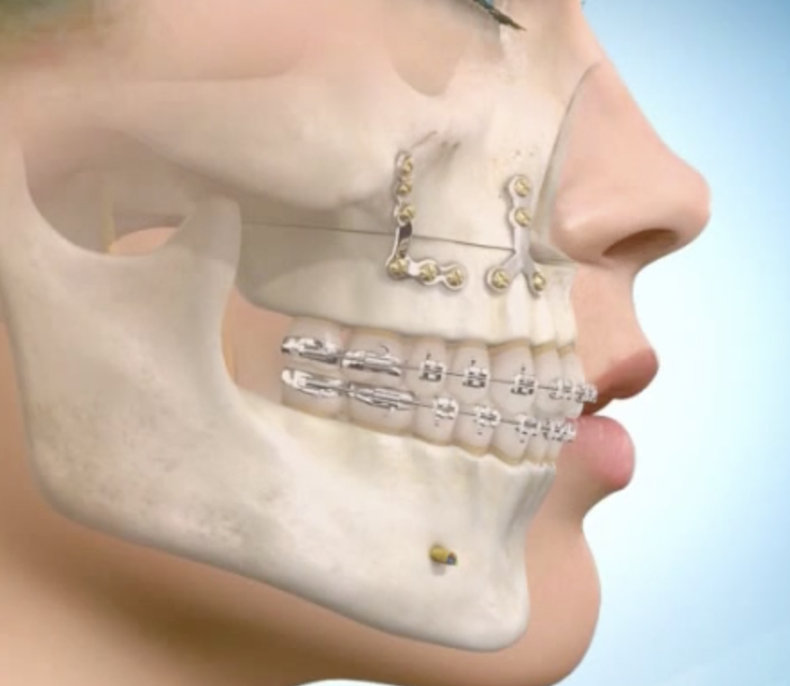 Chirurgie Orthognathique : Tout ce qu’il faut savoir