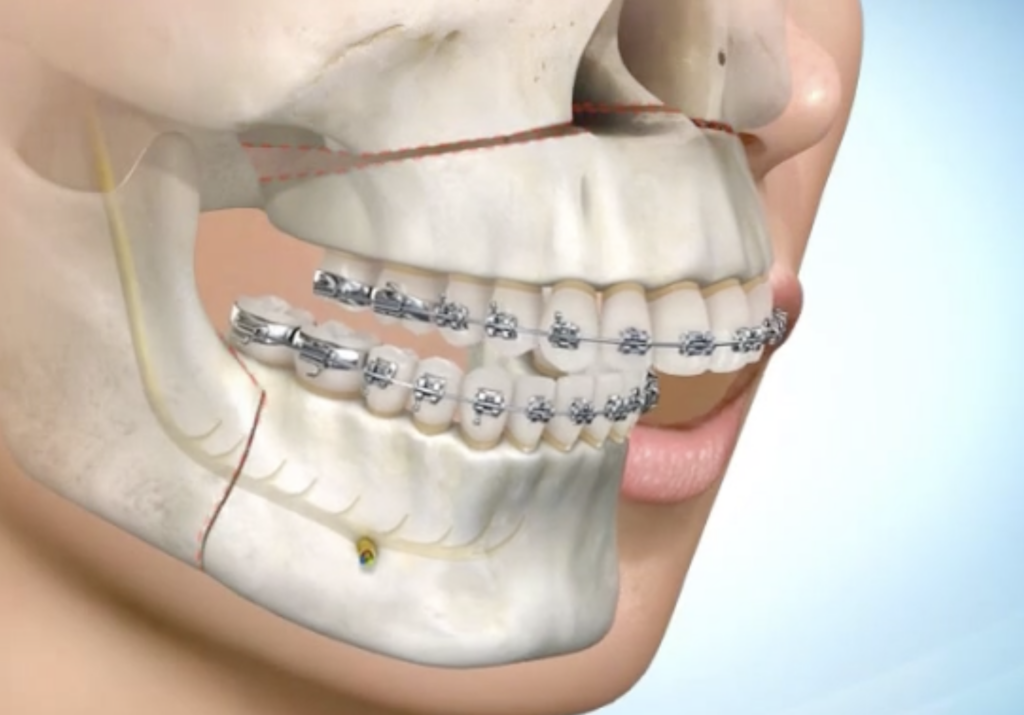 Chirurgie Orthognathique : Tout ce qu’il faut savoir