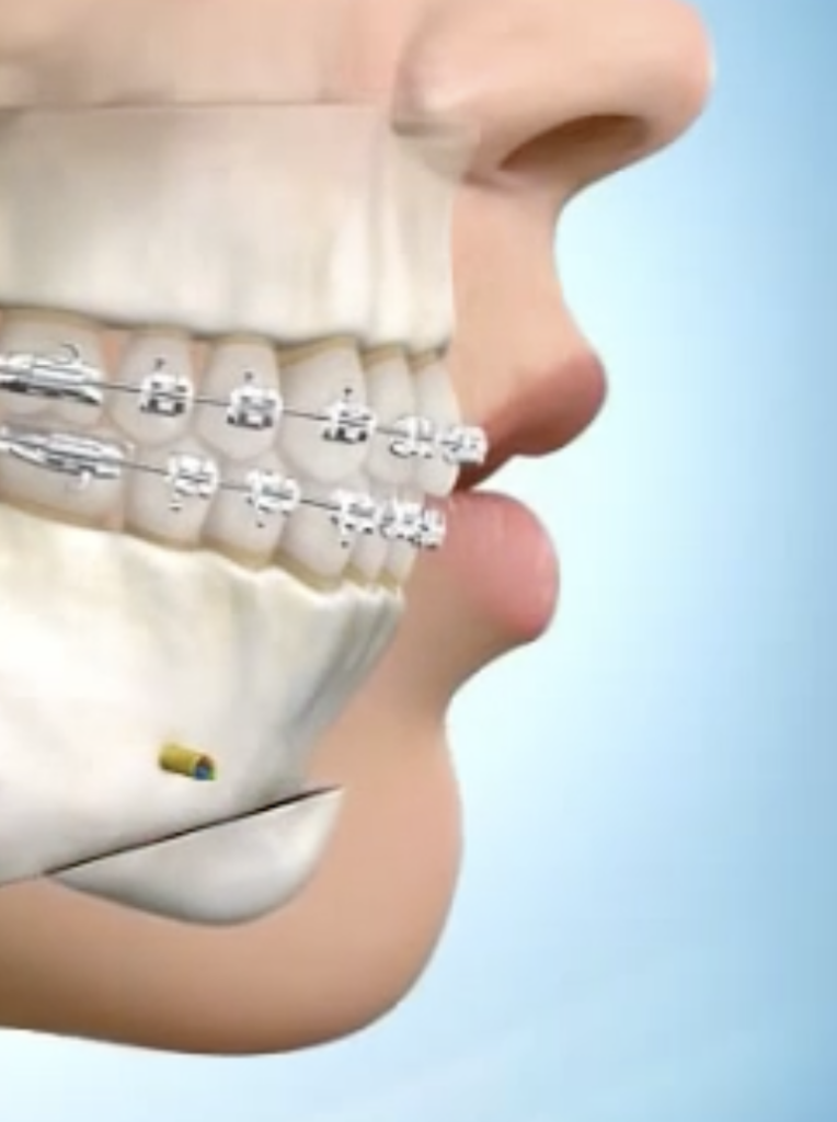 Chirurgie Orthognathique : Tout ce qu’il faut savoir