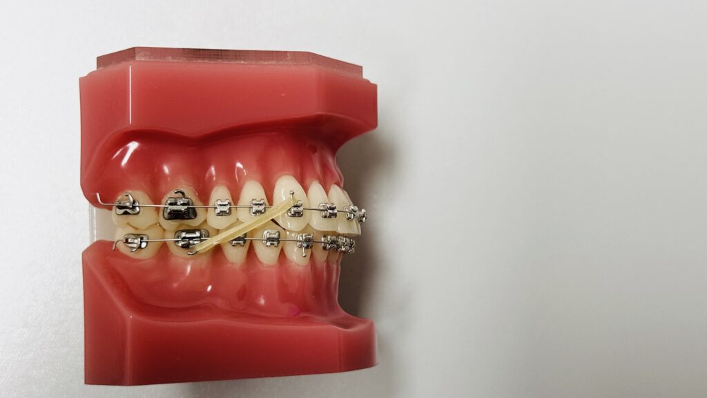 Les élastiques en orthodontie